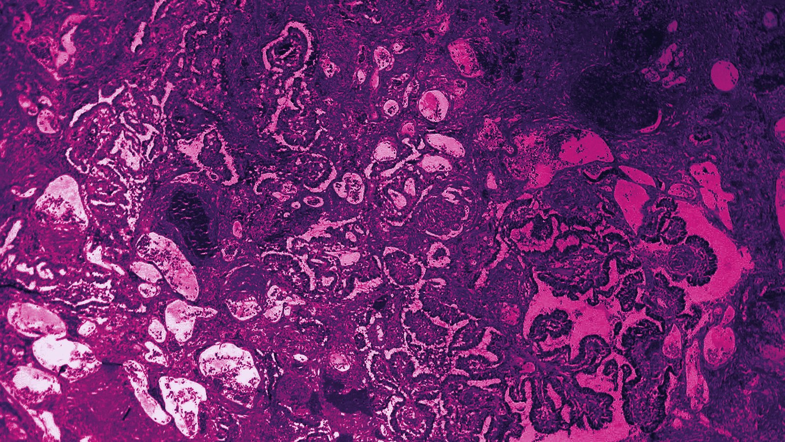Encapsulated papillary carcinoma of the breast, H&E. Ed Uthman, M.D., via Wikimedia Commons (CC BY 2.0)